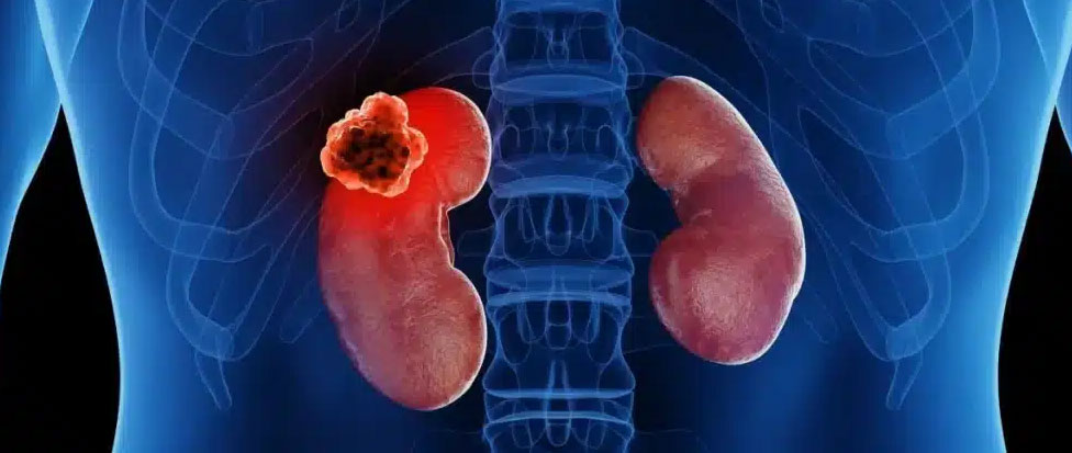 Kidney Cancer Services