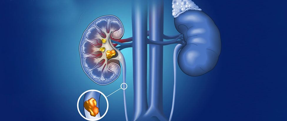 Kidney Stone Services