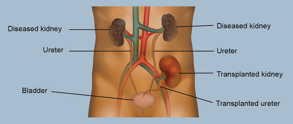 Kidney Transplant Services