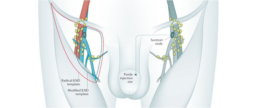Cancer of Penis Services